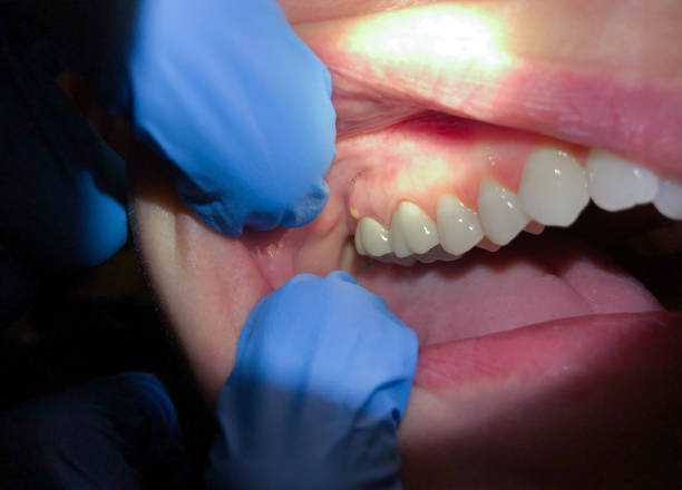 Best Emergency Broken Tooth Repair in Kirkland, WA